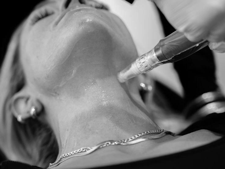 Mikrojehličkování — pleť + krk